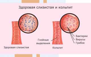 Как лечить кольпит у мужчин