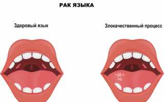 Симптомы рака языка