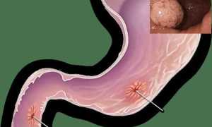 Как лечить язвенную болезнь