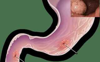 Как лечить язвенную болезнь