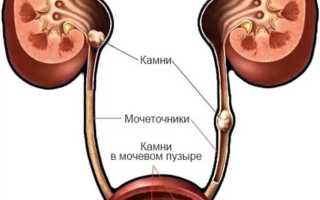 Эффективные методы для удаления камней в мочеточнике