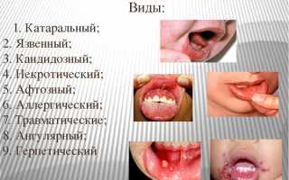 Как лечить стоматит у детей в домашних условиях