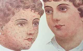 Лечение скарлатины у взрослых: эффективные методы и рекомендации