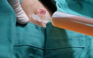 Суть и лечение серомы: все, что вам нужно знать