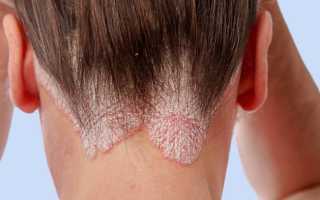 Избавление от грибка на голове: эффективные способы и советы