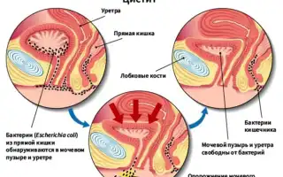 Как лечить цистит у женщин