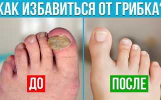 Как избавиться от грибка на ногтях ног