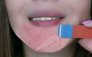 Как избавиться от прыщей