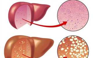 Симптомы ожирения печени