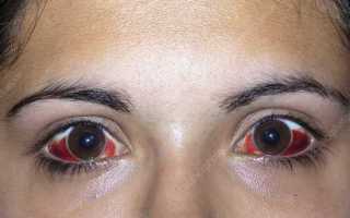 Как избавиться от красных сосудов в глазах