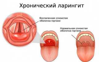 Лечение хронического ларингита