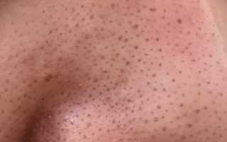 Удаление черных точек в домашних условиях: эффективные методы и советы