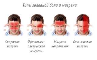 Все о мигрени симптомы лечение