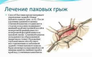 Пупочная и паховая грыжа – причины, симптомы и лечение