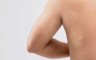 Как лечить солнечный лишай