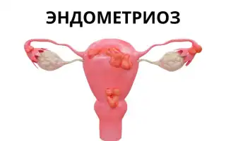 Возможно ли забеременеть при диагнозе эндометриоз?