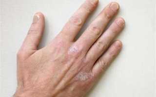 Как избавиться от экземы на руках