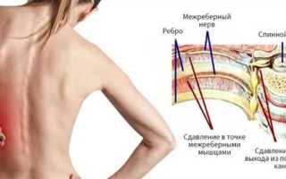 Как избавиться от межреберной невралгии