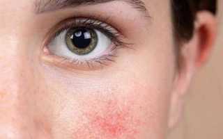 Что делать, если красные пятна на лице шелушатся