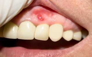 Как избавиться от воспаления десен