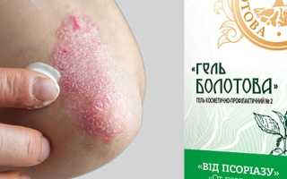 Лечение псориаза