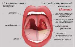 Симптомы ангины у детей