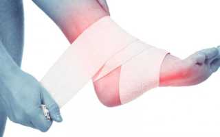 Лечение артроза стопы