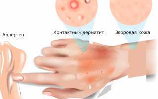 Как лечить кожную аллергию