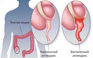 Первые признаки аппендицита у детей