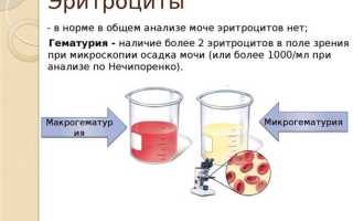 Как избавиться от эритроцитов в моче