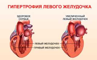 Особенности лечения гипертрофии левого желудочка сердца
