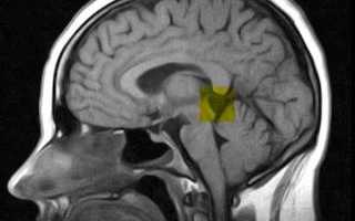 Киста шишковидной железы головного мозга