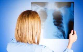 Заболевание саркоидоз легких и его лечение