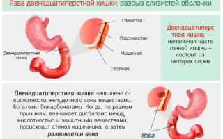 Как лечить язву двенадцатиперстной кишки