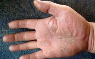 Красные пятна на ладонях и ступнях – опасно ли это