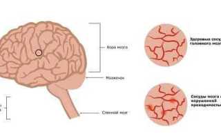 Делаем регионарную сосудистую терапию головного мозга