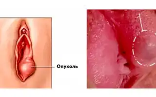 Понимание значения уплотнения на малой половой губе