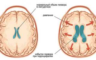 Наружная гидроцефалия головного мозга – причины и методы лечения