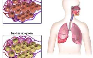 Аспирационная пневмония у новорожденных