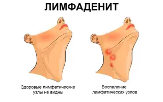 Способы лечения воспаленных лимфоузлов и их причины