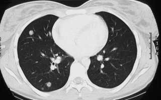 Множественные метастазы в легких