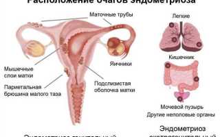 Можно забеременеть с эндометриозом?