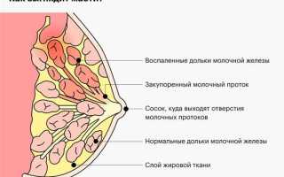Как лечить мастит народными средствами