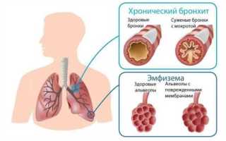 Бронхит Причины и симптомы бронхита