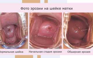 Как лечить эрозию при беременности