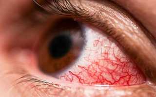 Как избавиться от красных белков глаз и отеков под глазами