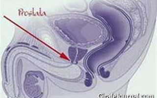 Симптомы рака предстательной железы