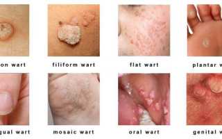 Признаки ВПЧ