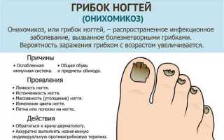 Как избавиться от грибка на ногах