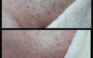 Покраснение в паховой области у мужчины: причины и лечение